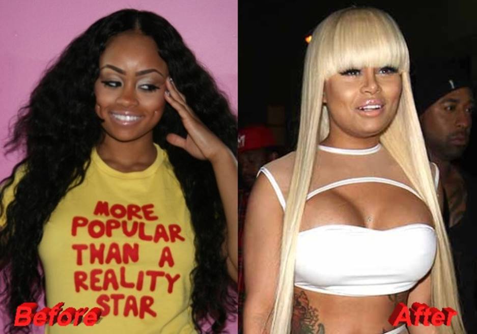 Desde Arriba Blac Chyna S Before And After Photos Tell The Real Deal With Her Plastic Surgery