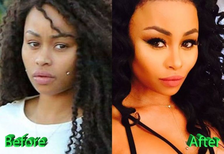 Desde Arriba Blac Chynas Before And After Photos Tell The Real Deal With Her Plastic Surgery